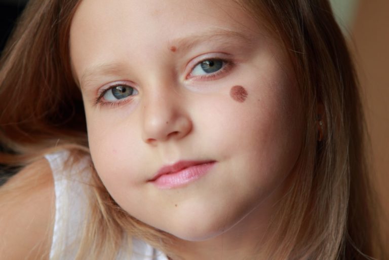 tache de naissance sur le visage de la fille